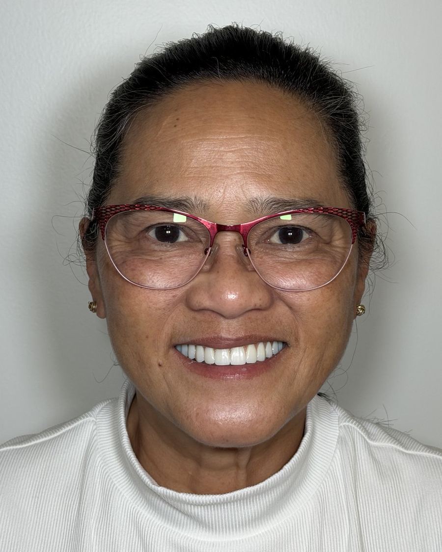 Full mouth reconstruction after photo — the same patient with an even, full-height upper arch rebuilt
