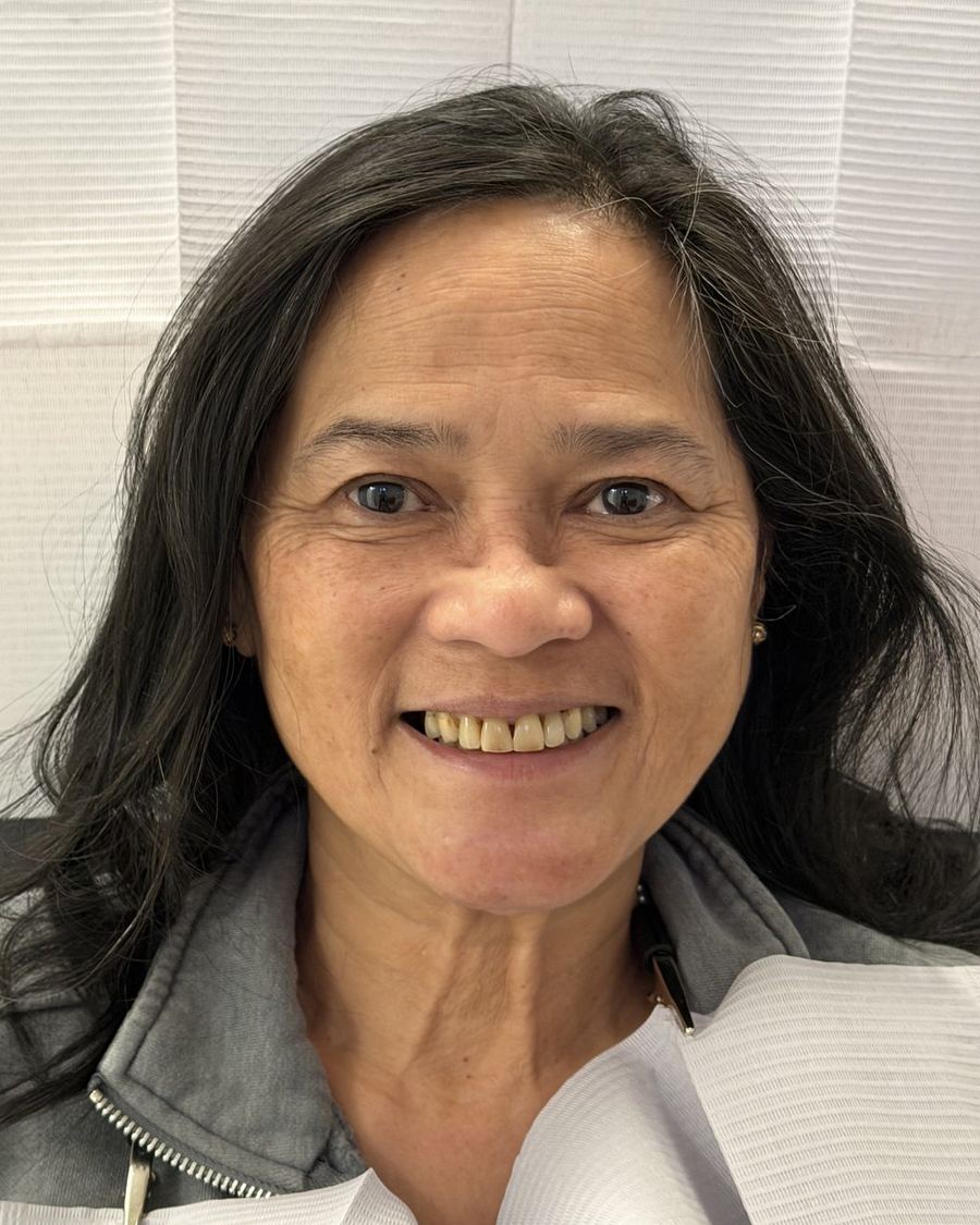 Full mouth reconstruction before photo — worn, discolored upper front teeth separated by gaps