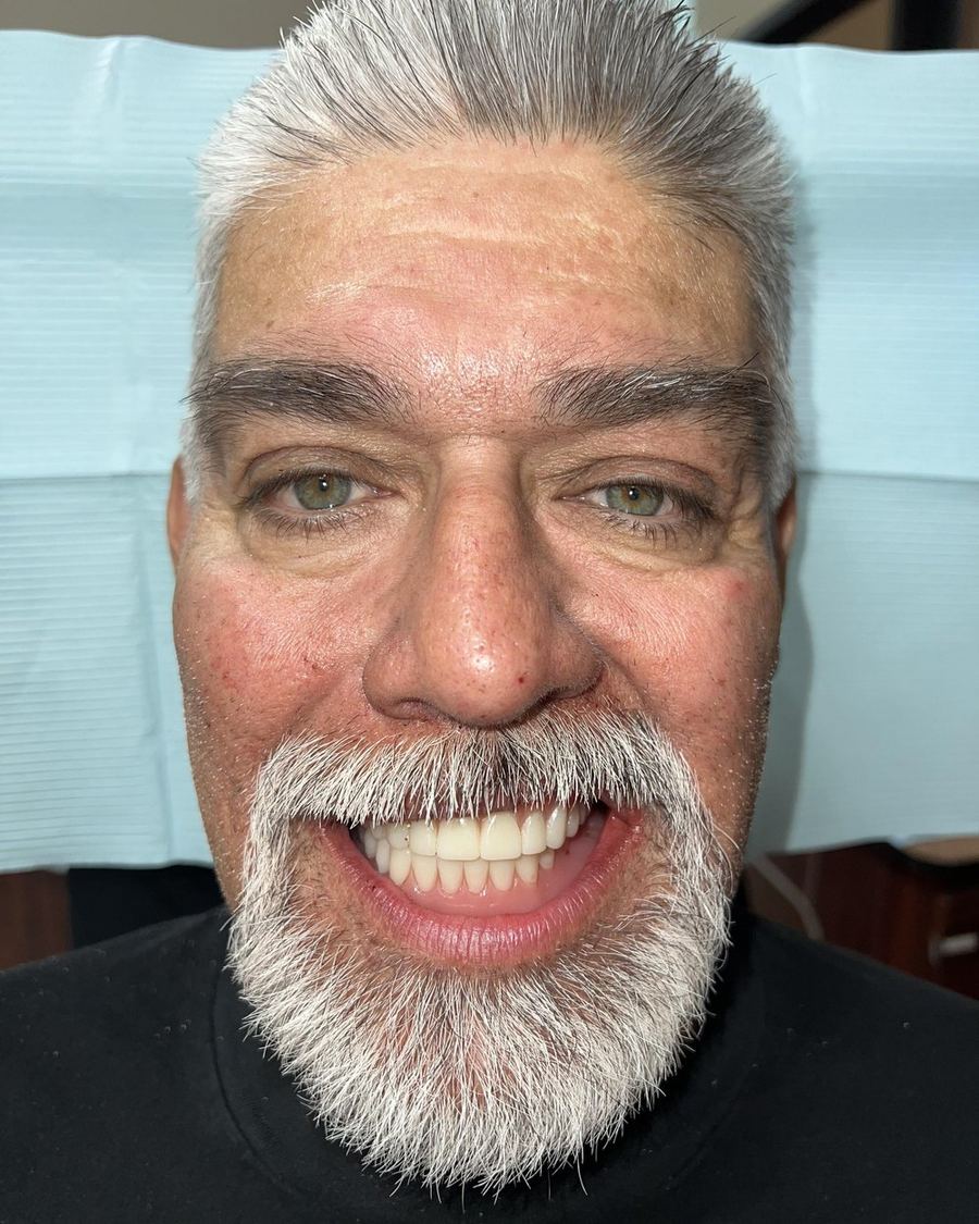 Full-arch reconstruction after photo — the same patient with a complete restored smile