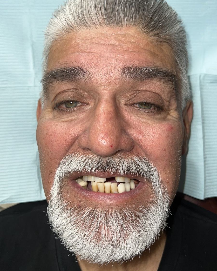 Full-arch reconstruction before photo — fractured, worn, and missing teeth across both arches