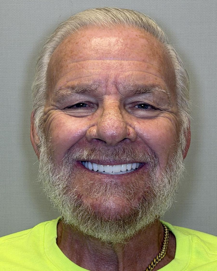 Full-arch implant reconstruction after photo — the same patient with upper and lower arches restored