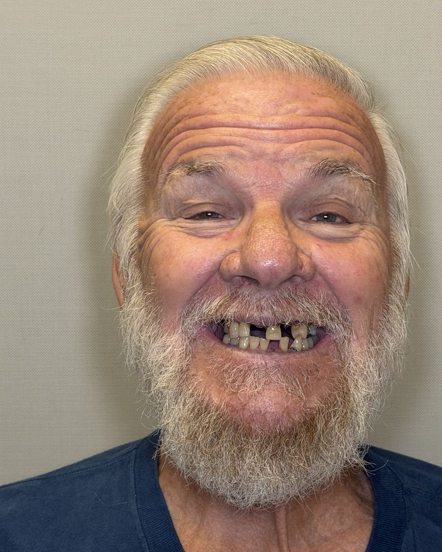 Full-arch implant reconstruction before photo — only a few broken, failing teeth remaining